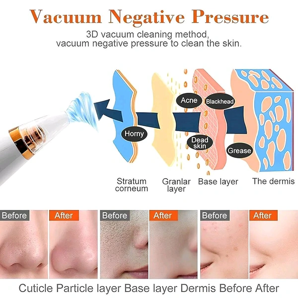 Multi-Functional Blackhead Remover – Electric Pore Vacuum Cleaner
