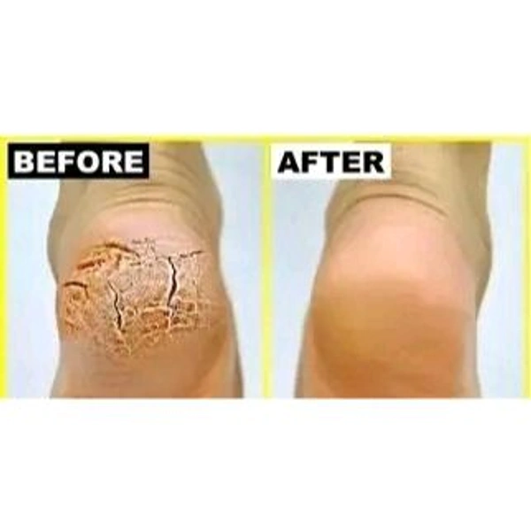 WaYFaR Foot Crack Cream For Dry Cracked Heels & Feet (50gm) Pack of 1