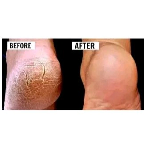 WaYFaR Foot Crack Cream For Dry Cracked Heels & Feet (50gm) Pack of 1