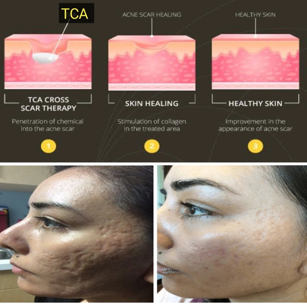 A TCA Cross 80% For Deep Acne Scars,Moles,Warts.