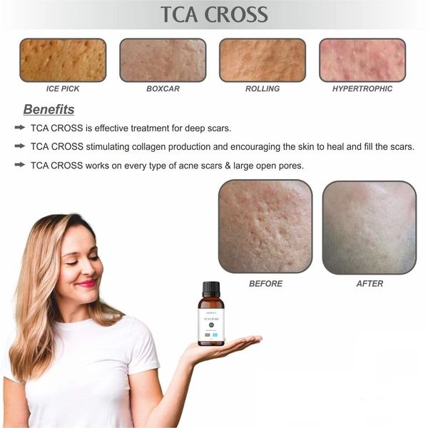 A TCA Cross 80% For Deep Acne Scars,Moles,Warts.