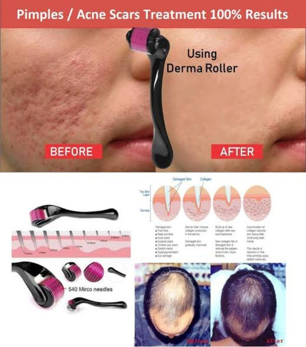 V Pro Derma Roller Set - 0.5 mm Roller with Free 1.5 mm Roller for Acne Scars, Open Pores, Smooth and Radiant Skin - 0.5 MM & 1.5 MM