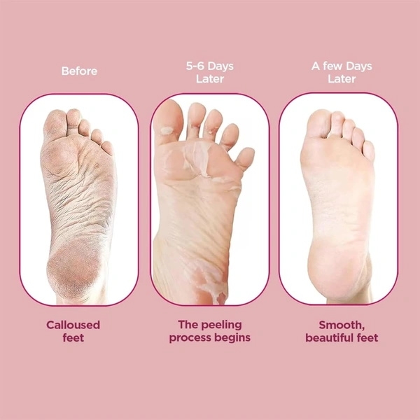 Furr by Pee Safe Peeling & Exfoliating Foot Mask for Unisex use| Glycolic & Salicylic Acid | Reduces Dry Skin & Hard Calluses | Moisturizes & Hydrates Feet | Nourishing Sock-Style Foot Mask