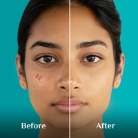 Pilgrim 10% Niacinamide Face Serum - 30ml | For Acne Marks | With 1% Zinck PCA Korean White Lotus | Fades Blemishes & Dark Spots | Controls Oil & Hydrates | Even Skin Tones | Acne Control Serum | Pore-Minimizing | For All Skin Types