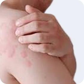 Allergy
