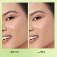 Quench Zit Away Acne Pimple Patches for Face (24 Patches in pack)  - Quench