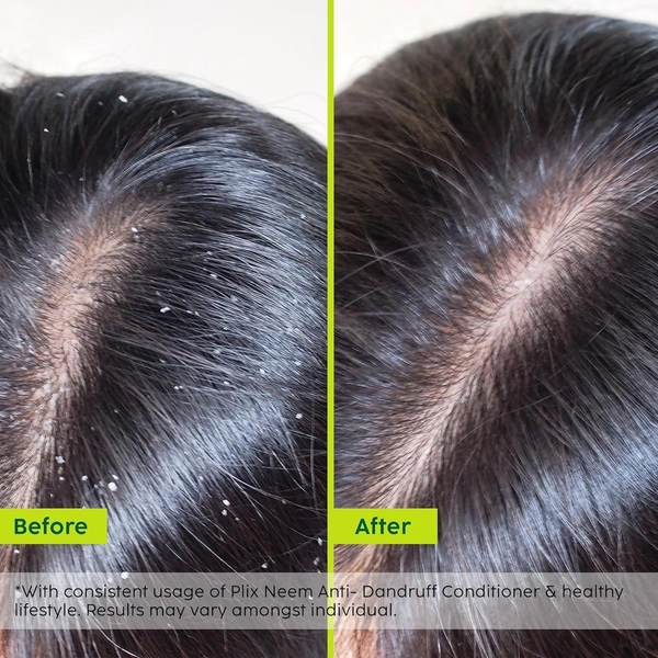 PLIX - THE PLANT FIX Neem Anti-Dandruff Advanced Conditioner | Reduces Dandruff, Dryness & Frizz | With Dandelix Pro™ & Murumuru Butter | Locks in Moisture | Paraben & Sulphate Free | For Men & Women | 175 ml