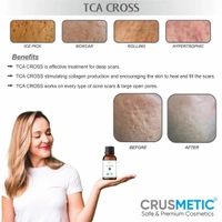 A TCA Cross 80% - Acne Scars Solution
