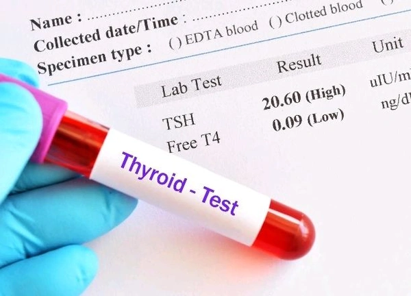 Thyroid Profit ( T3,T4,TSH) Test